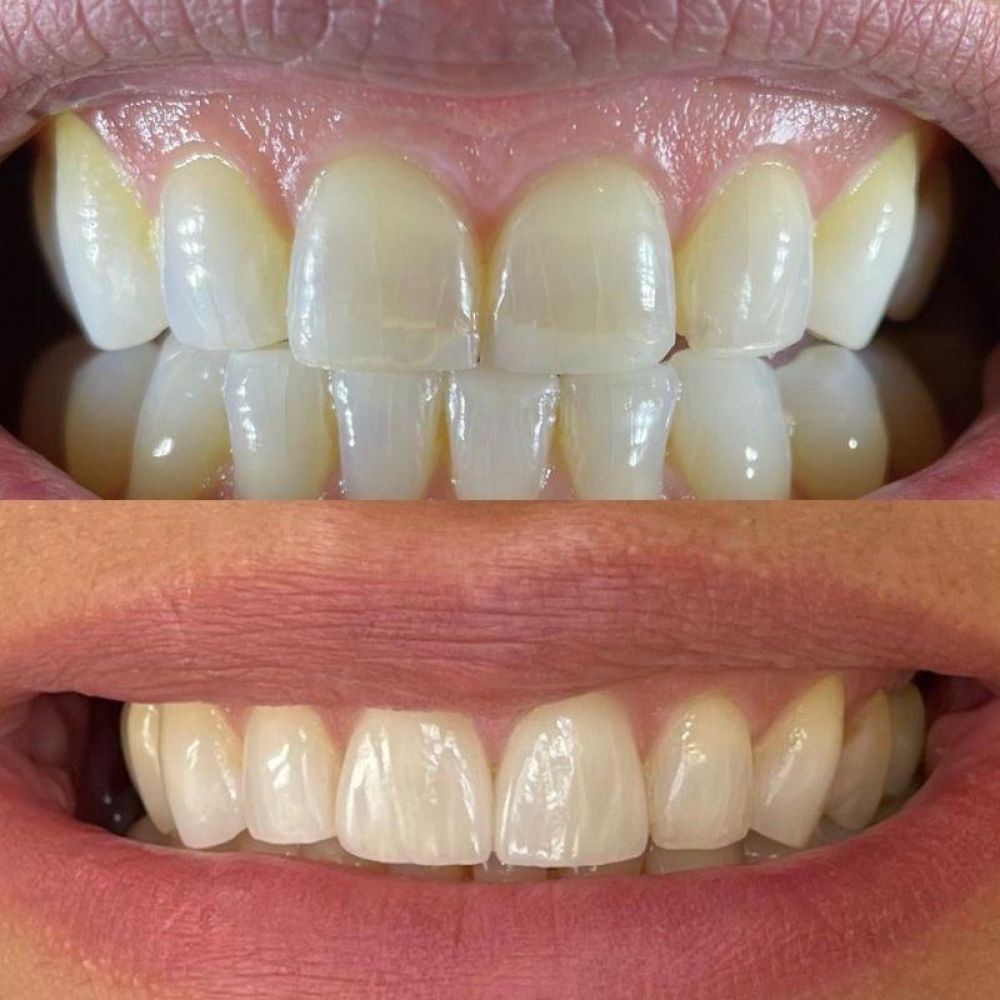 Before and after treatment at Queens Drive Dental in Glasgow 