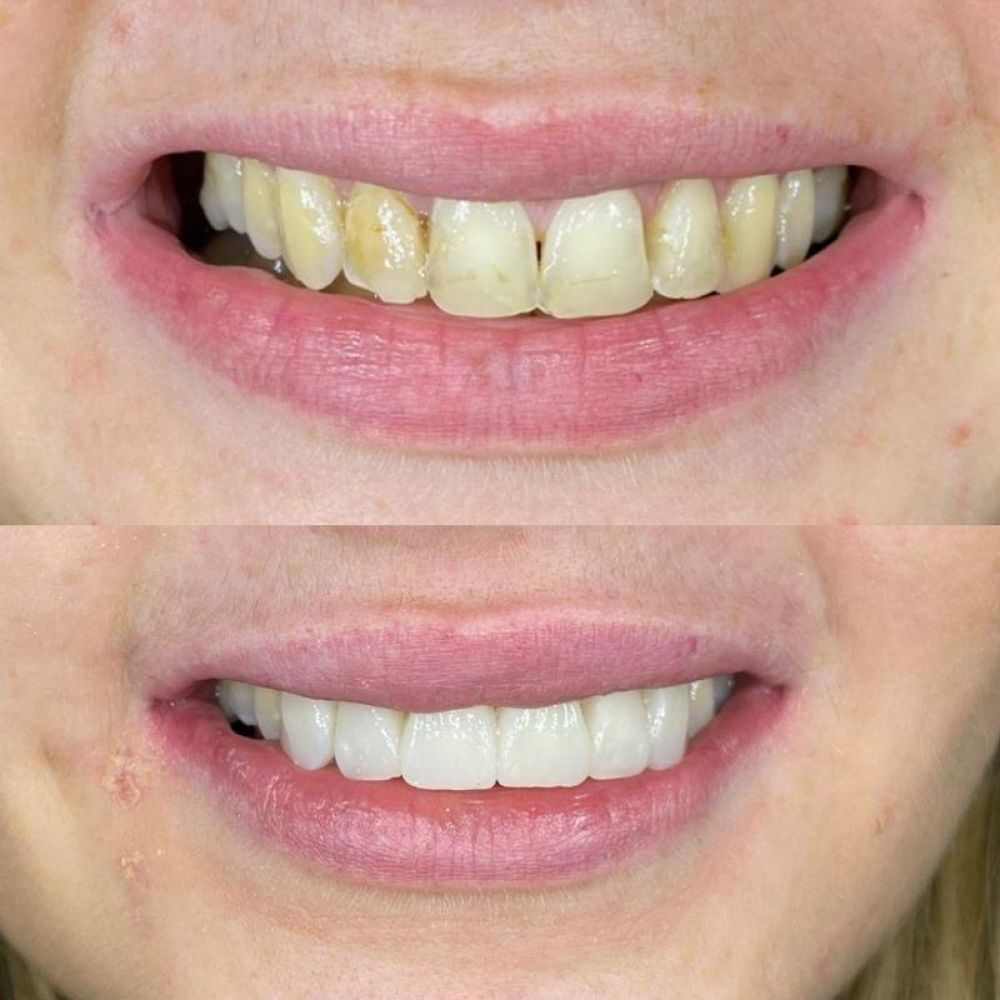 Before and after treatment at Queens Drive Dental in Glasgow 