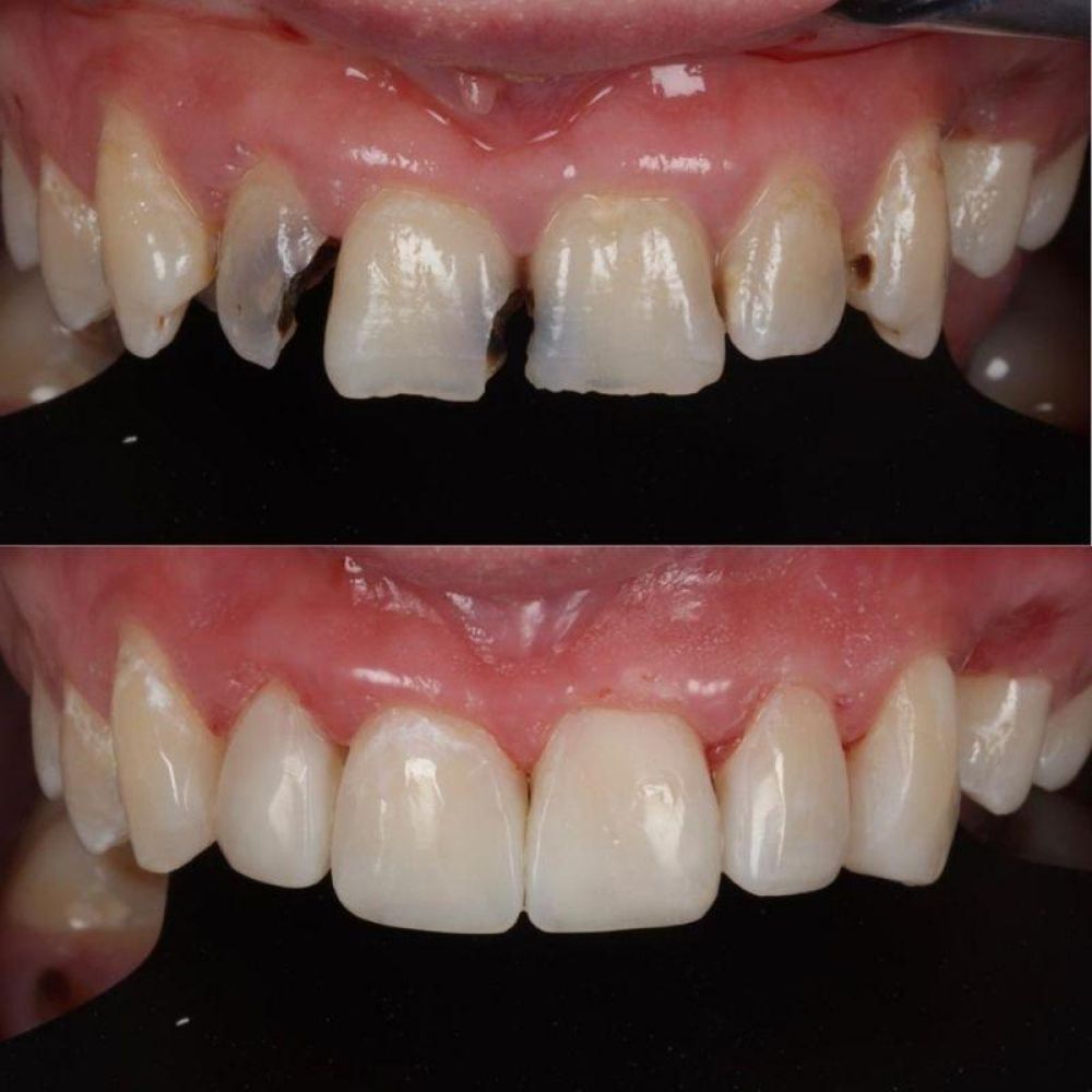 Before and after treatment at Queens Drive Dental in Glasgow 