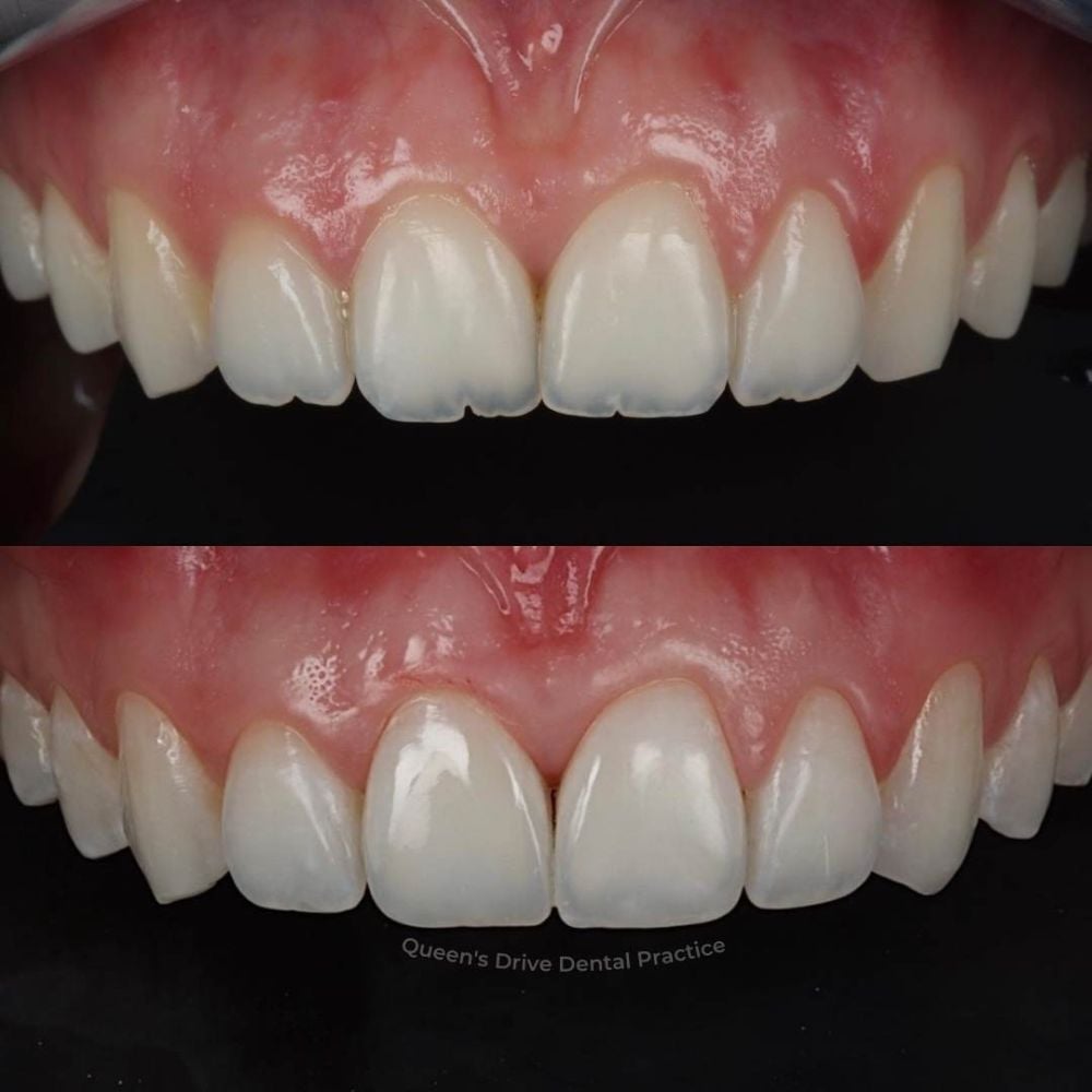 Queens Drive Dental Practice | Queens Drive Dental Practice, Glasgow Before and after treatment at Queens Drive Dental in Glasgow