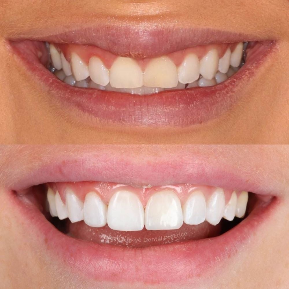 Queens Drive Dental Practice | Queens Drive Dental Practice, Glasgow Before and after treatment at Queens Drive Dental in Glasgow