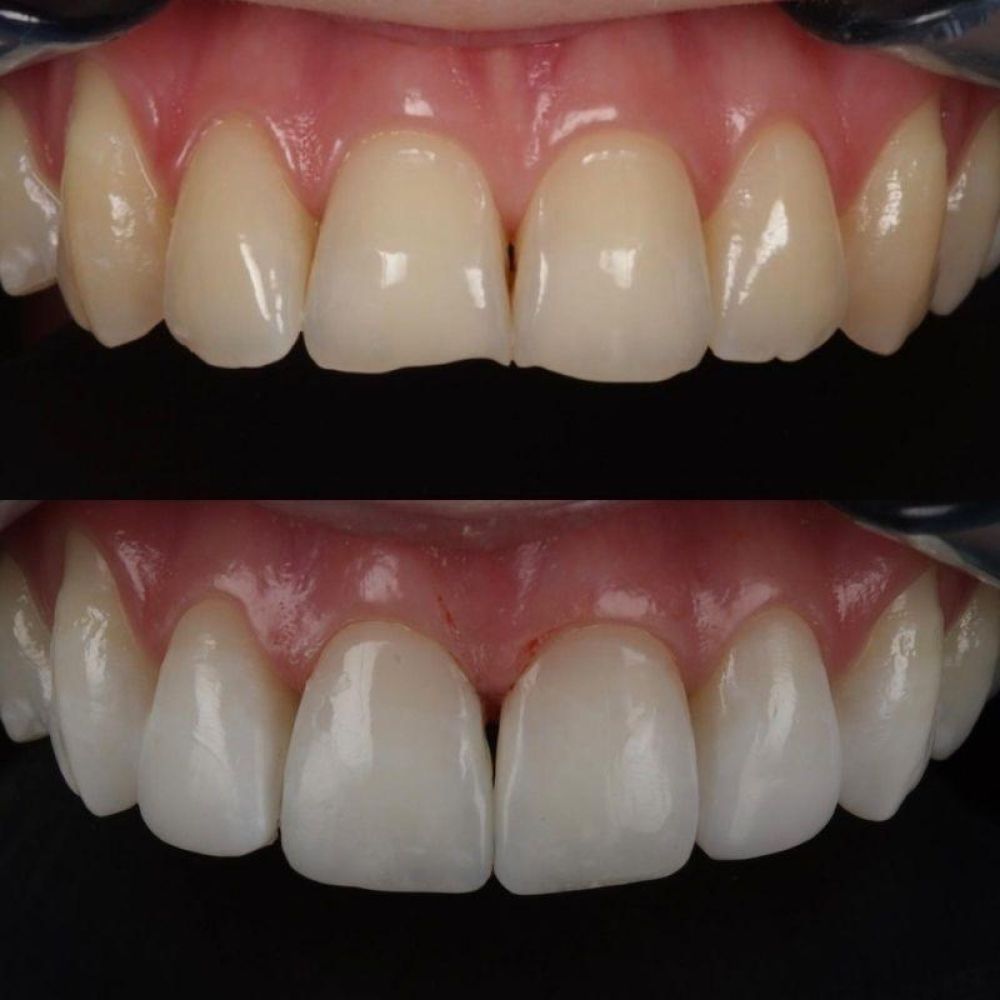 Before and after treatment at Queens Drive Dental in Glasgow 