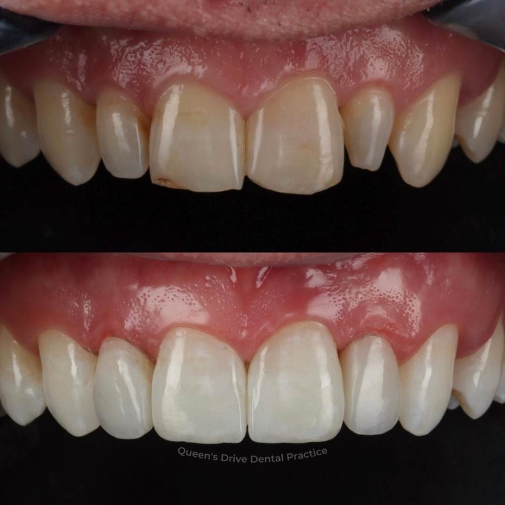 Queens Drive Dental Practice | Queens Drive Dental Practice, Glasgow Before and after treatment at Queens Drive Dental in Glasgow