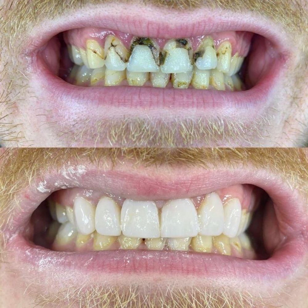 Before and after treatment at Queens Drive Dental in Glasgow 
