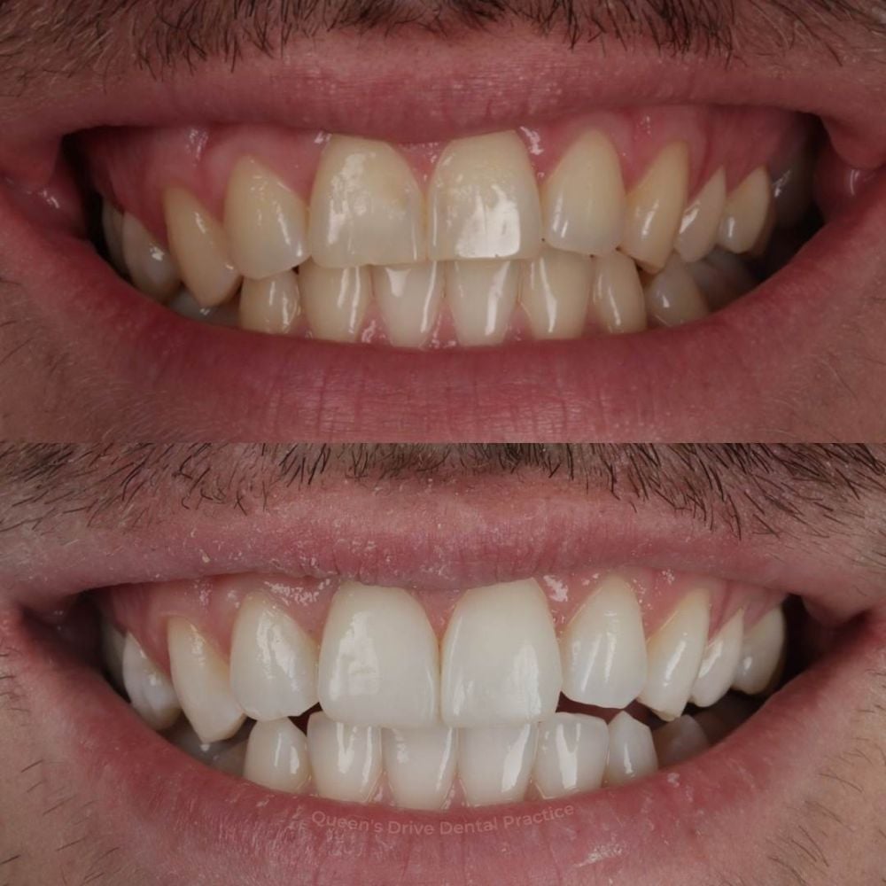 Queens Drive Dental Practice | Queens Drive Dental Practice, Glasgow Before and after treatment at Queens Drive Dental in Glasgow